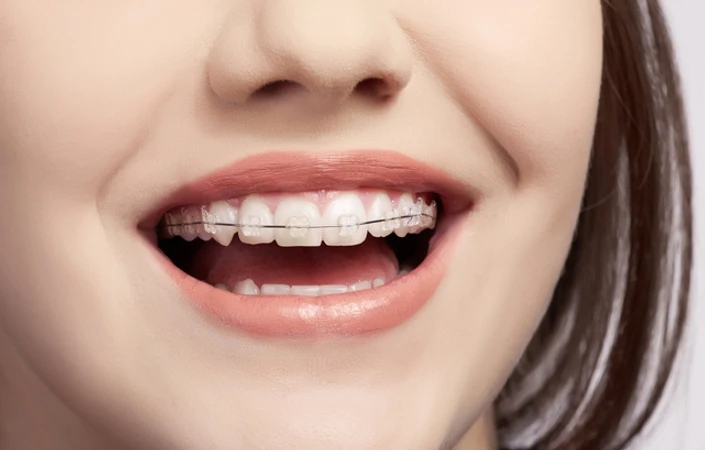 Pemasangan Behel Self Ligating Clear Damon + Rontgen Gigi Pramita Lab di Klinik Gigi Senyum Ceria