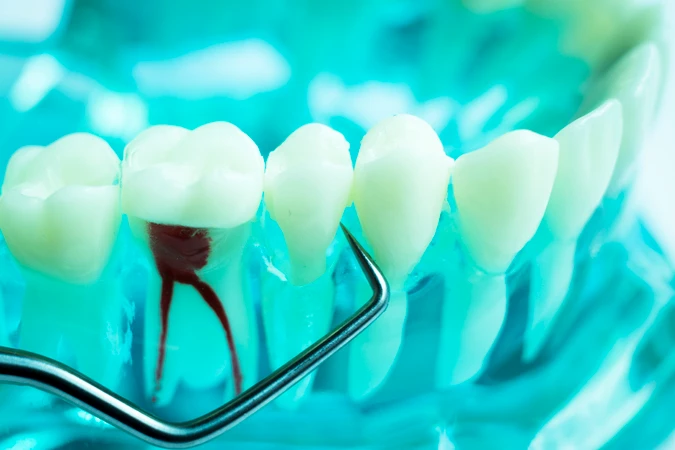 Perawatan saluran akar gigi (per akar) 1x di PI Dental Care