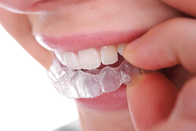 Retainer Lepasan 2 Rahang di Embun Galaxi Dental Care