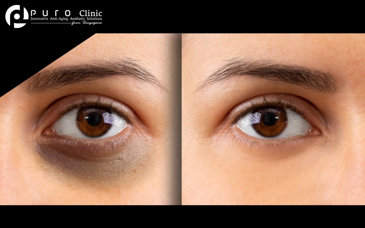 First Time Purchase: Eyes Dark Circle Laser treatment 1x di Puro Clinic