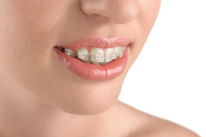 Pasang Behel Keramik oleh drg. Umum di A+ Dental Care