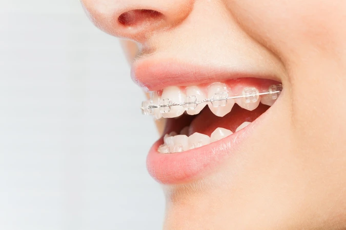 Pemasangan Behel Self Ligating Clear Damon di A+ Dental care