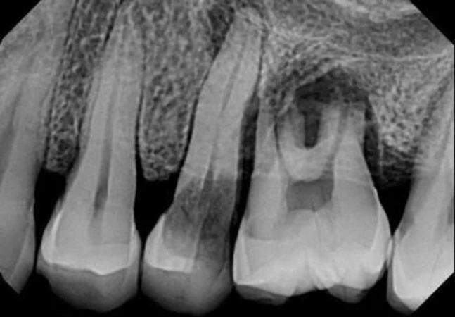 Rontgen Periapikal di Griya Denta Clinic