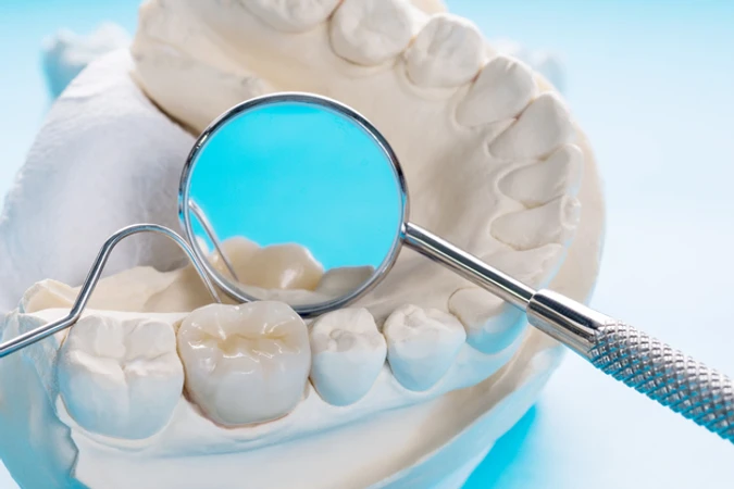 Tambal Gigi di Schon Dental