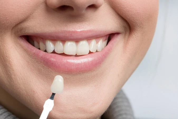 Direct Veneer Komposit di Ananta Dental