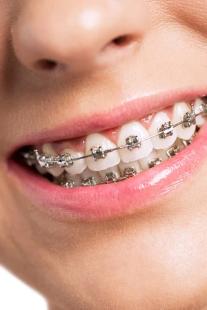 Pasang Behel Damon Metal Quantum oleh drg. Spesialis Ortodontik di Alea Dental