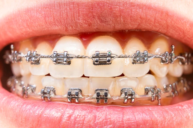 Pasang Behel Damon Metal di Dentalogy Clinic