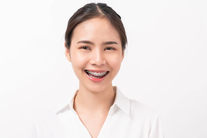 Pasang Behel Damon Metal di Klinik Gigi Dewi