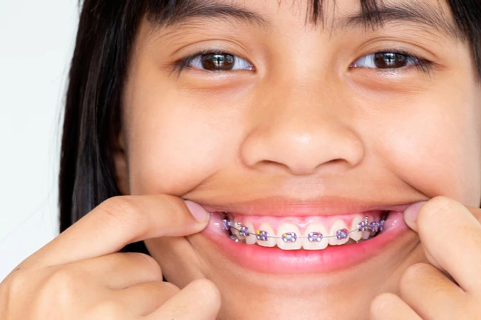 Pasang Behel Sapphire di Ananta Dental