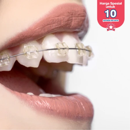 Pemasangan Behel Self Ligating Damon Clear oleh Dokter Gigi Spesialis Ortodonti di Dentistique Clinic