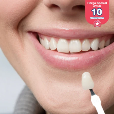 Direct Veneer Komposit 16 Gigi di Fre Dental Care