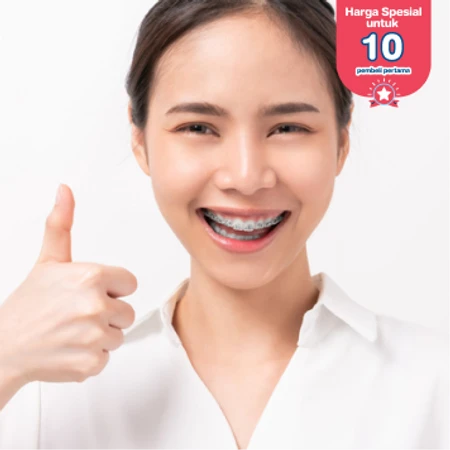 Pasang Behel Self Ligating di Empire Dental Studio