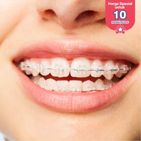 Pasang Behel Keramik di My Dental Studio