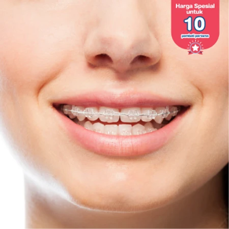 Pasang Behel Keramik di Empire Dental Studio