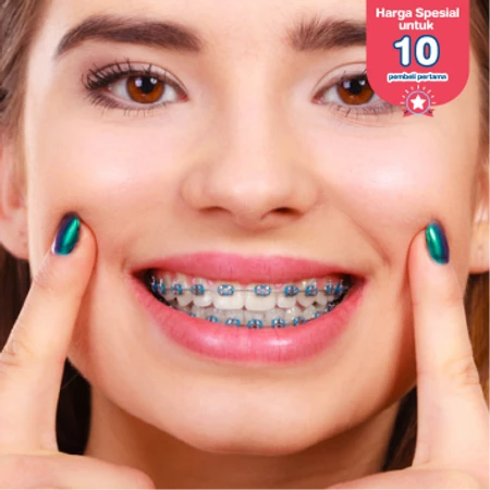 Pasang Behel Metal oleh drg. Spesialis Ortodontik di Dentistique Clinic