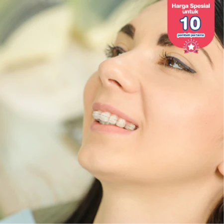 Pasang Behel Keramik oleh drg. Spesialis Ortodontik di Klinik Gigi Griya Denta