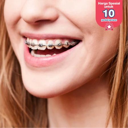 Pasang Behel Damon Metal oleh drg. Spesialis Ortodontik di Klinik Gigi Griya Denta