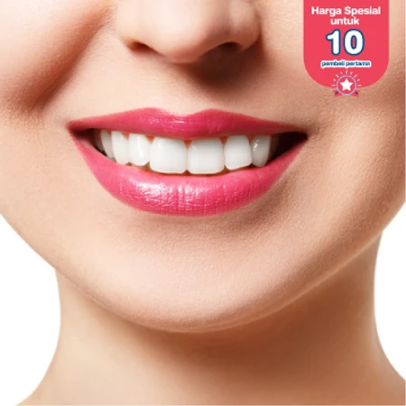 Bleaching Gigi + Konsultasi di Drg. Anggi Dental Clinic