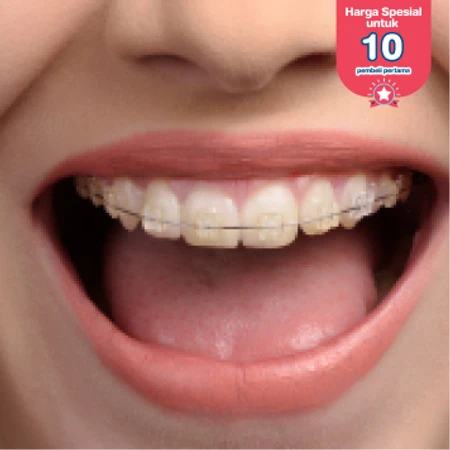Pasang Behel Sapphire oleh drg. Spesialis Ortodontik di Klinik Tooth Signature
