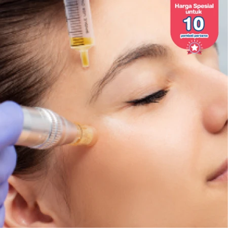 Filler 1x di D Elegance Clinic