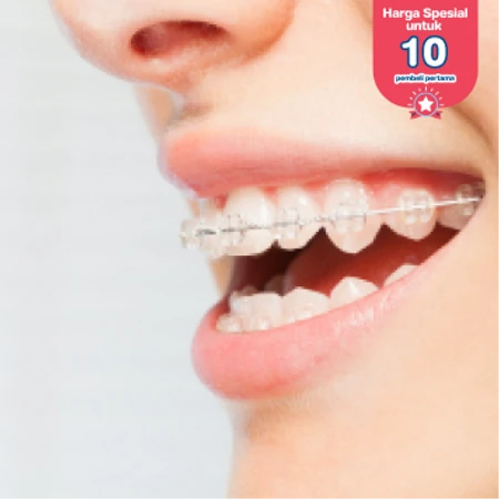 Pasang Behel Self Ligating di Dian Yunita Dental Care