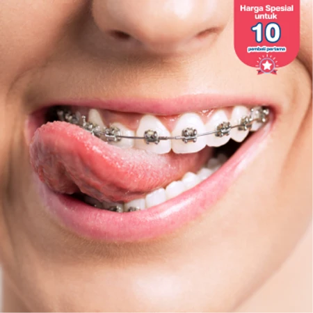 Pasang Behel Metal oleh drg. Umum di Lulu Medika