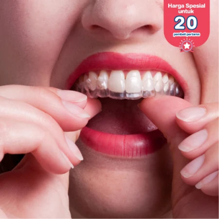 Retainer Lepasan Essix Clear 1 Rahang di Dentistique