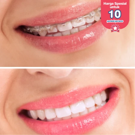 Pasang Behel Shappire oleh drg. Umum di Dental Theory