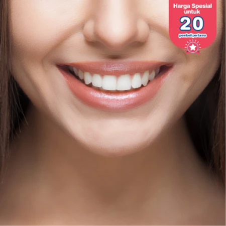 Bleaching Gigi di Empire Dental Studio