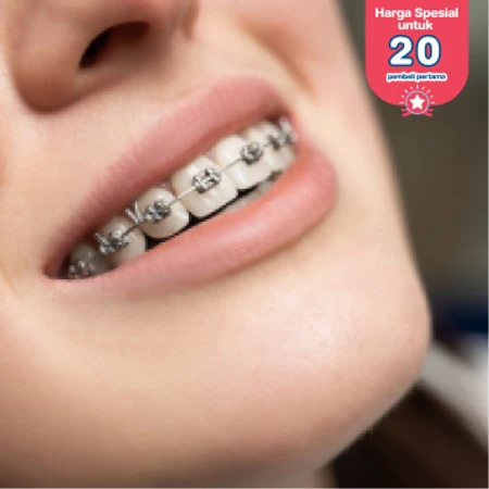 Pasang Behel Metal oleh drg. Umum di Ocean Dental