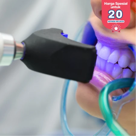 Bleaching Gigi dengan LED + Scaling Gigi di Klinik Gigi Dentalosophy