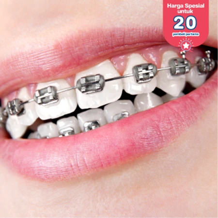 Pasang Behel Metal di Infinity Dental Studio