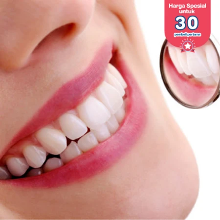 Scaling Gigi + Stain Removal di Akatara Clinic