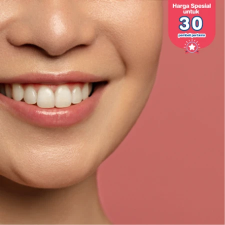 Direct Veneer Komposit oleh drg. Spesialis Prostodonsia di Akatara Clinic