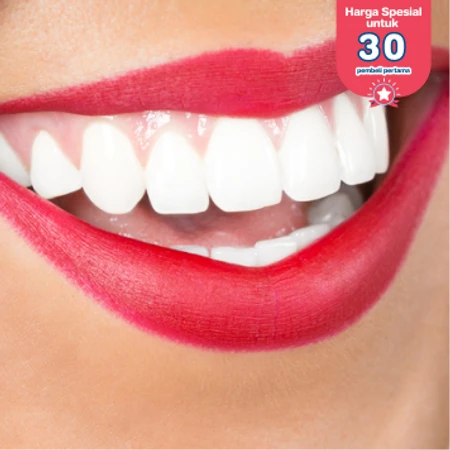 Bleaching Gigi di AM Dental Care Gading Serpong