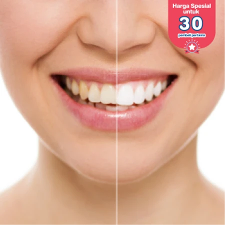 Bleaching Gigi di Klinik Gigi drg. Mia