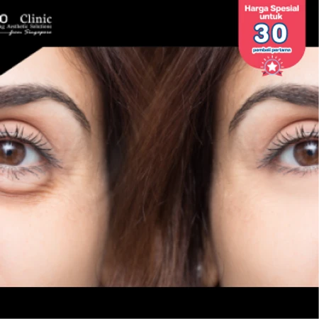 HIFU Area Mata (First Time Purchase) di Puro Clinic