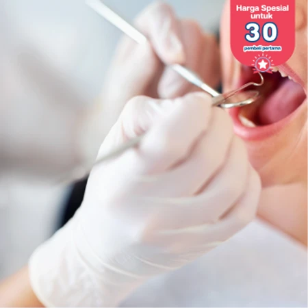 Direct Veneer Komposit 2 Gigi di DENTALMATE DENTALCARE