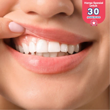 Bleaching Gigi dengan LED + Scaling Gigi + Polishing + Topical Fluoride di DENTALMATE DENTALCARE