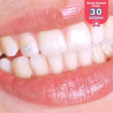 Lepas Bracket + Scaling dan Polishing + Fluoride Treatment di DENTALMATE DENTALCARE