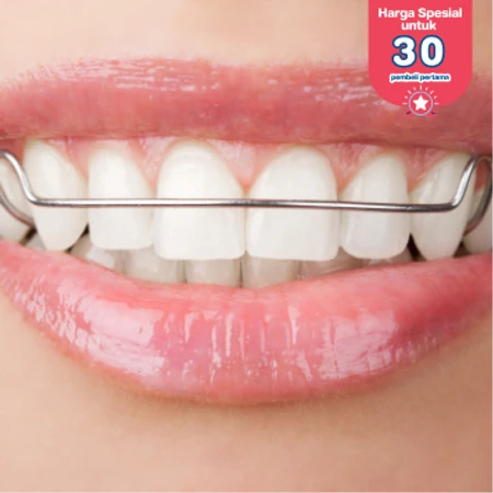 Retainer Lepasan Hawley 2 Rahang + Cetak Gigi di DENTALMATE DENTALCARE
