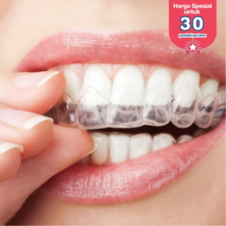 Retainer Lepasan Clear 2 Rahang + Cetak Gigi di DENTALMATE DENTALCARE
