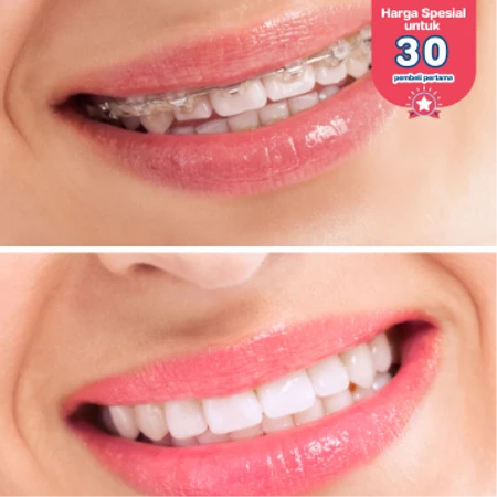 Paket Lepas Behel di Klinik Gigi drg Mia