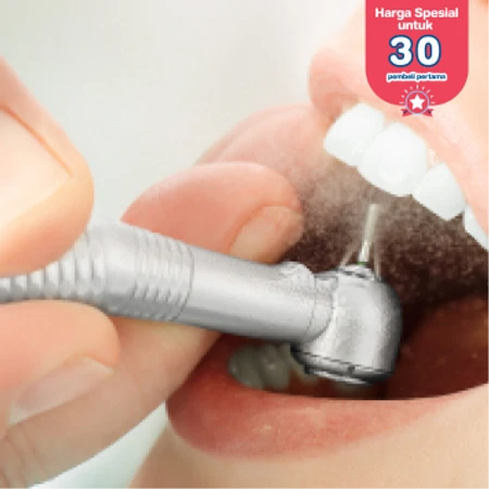 Scaling Gigi + Pemeriksaan gigi + Polishing di D Dental Care