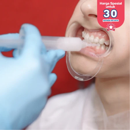 Bleaching Gigi dengan LED + Scaling Gigi + Desensitisasi di D Dental Care