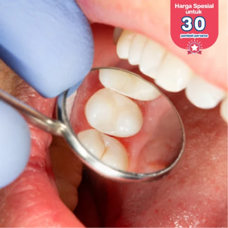 Crown Lengthening di D Dental Care