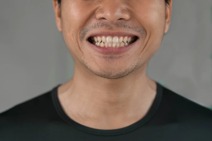 Veneer Komposit 6 Gigi di Infinity Dental Studio