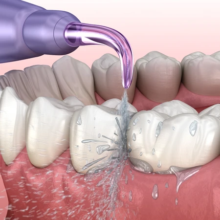 Scaling Gigi di Gigiku Family Dental Care