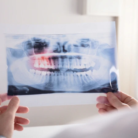 Rontgen Periapikal di Praktik drg. Nina Miranti