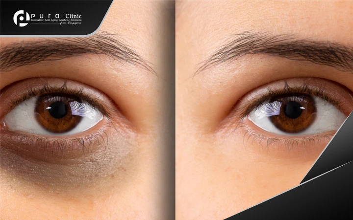 Eyes Dark Circle Laser di Puro Clinic